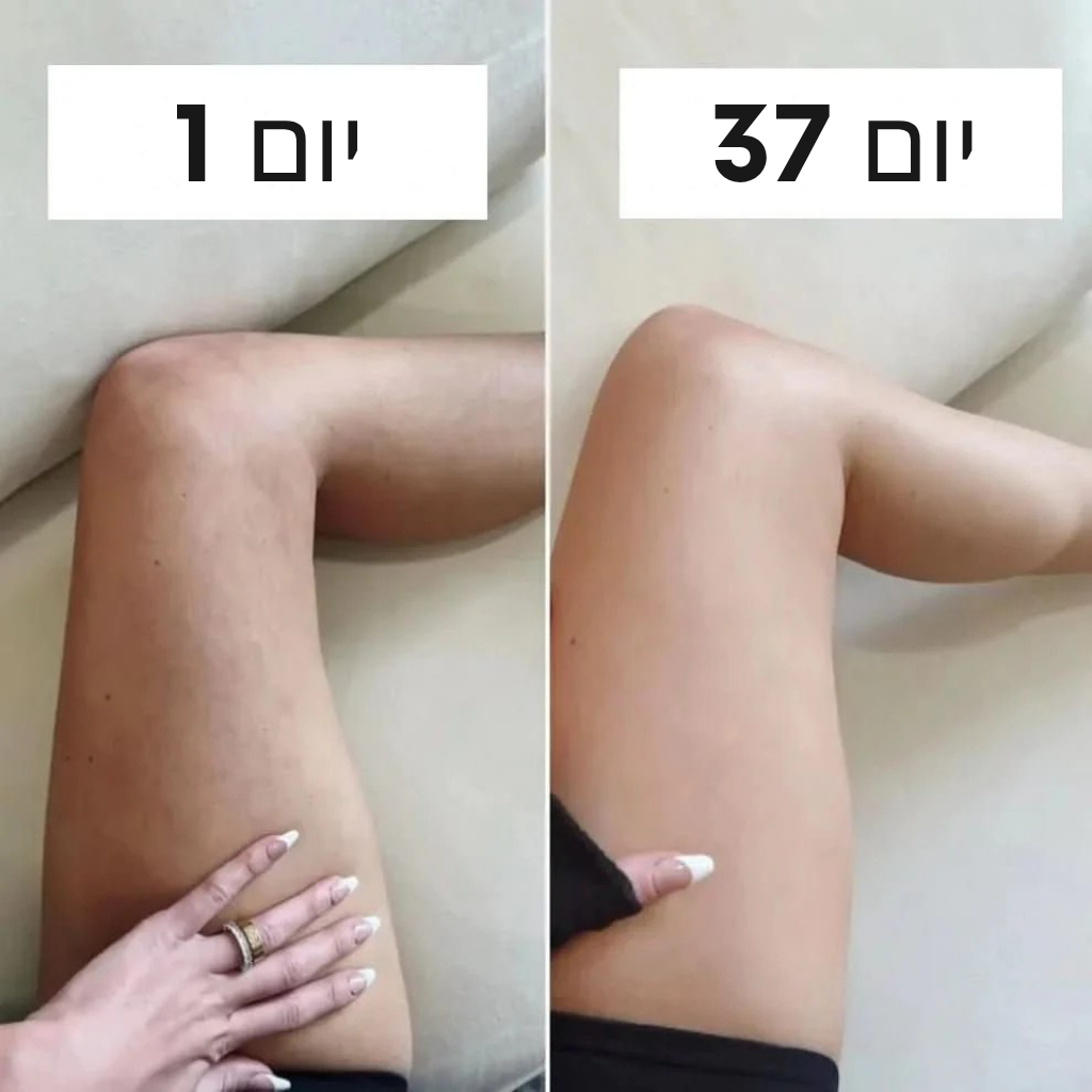 TalyaSkin. ערכת להקלה על צלוליטיס